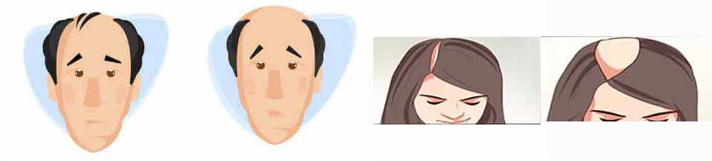 types of baldness